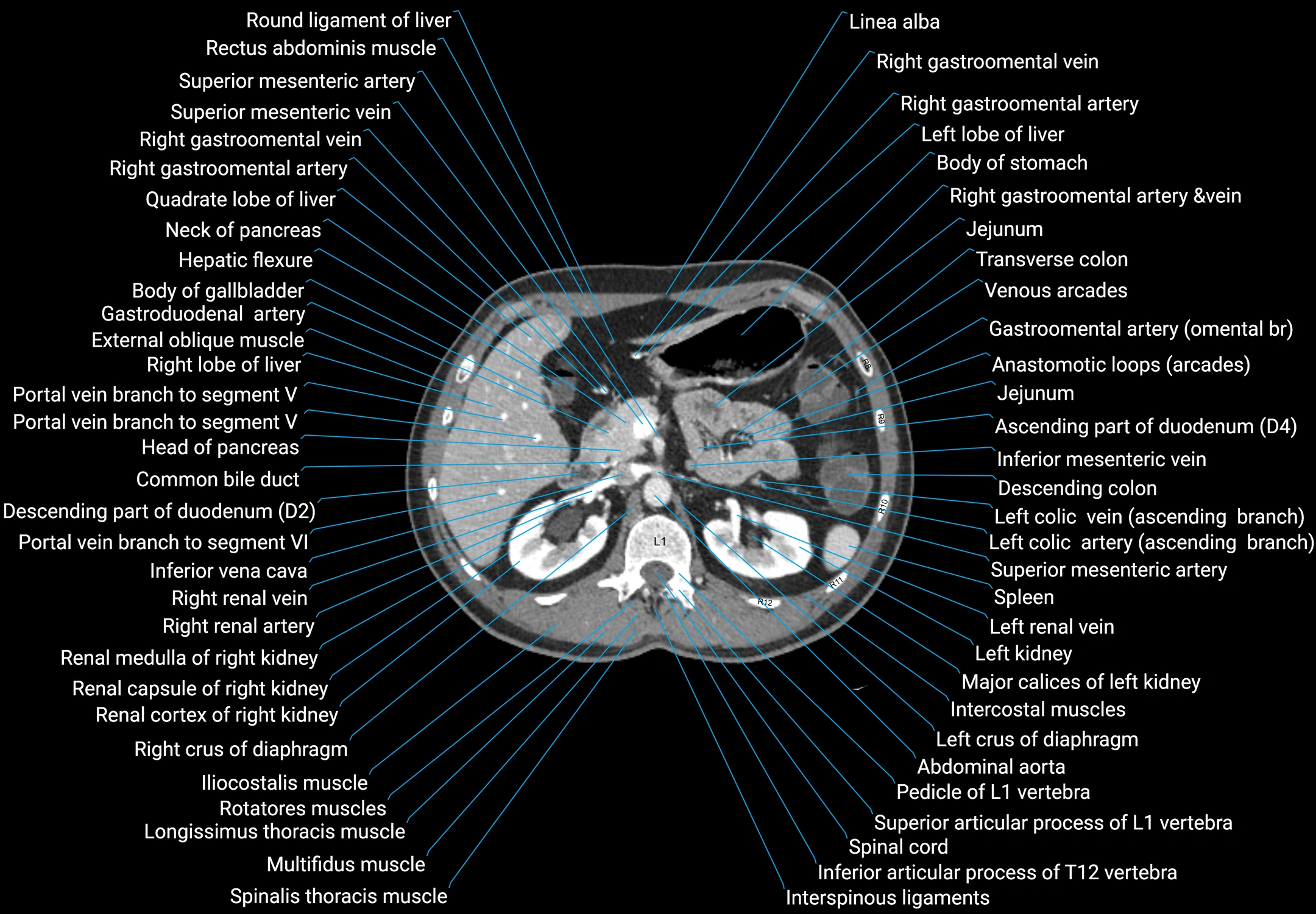 CT male pelvis axial cross sectional anatomy labelled radiology image -00055.webp